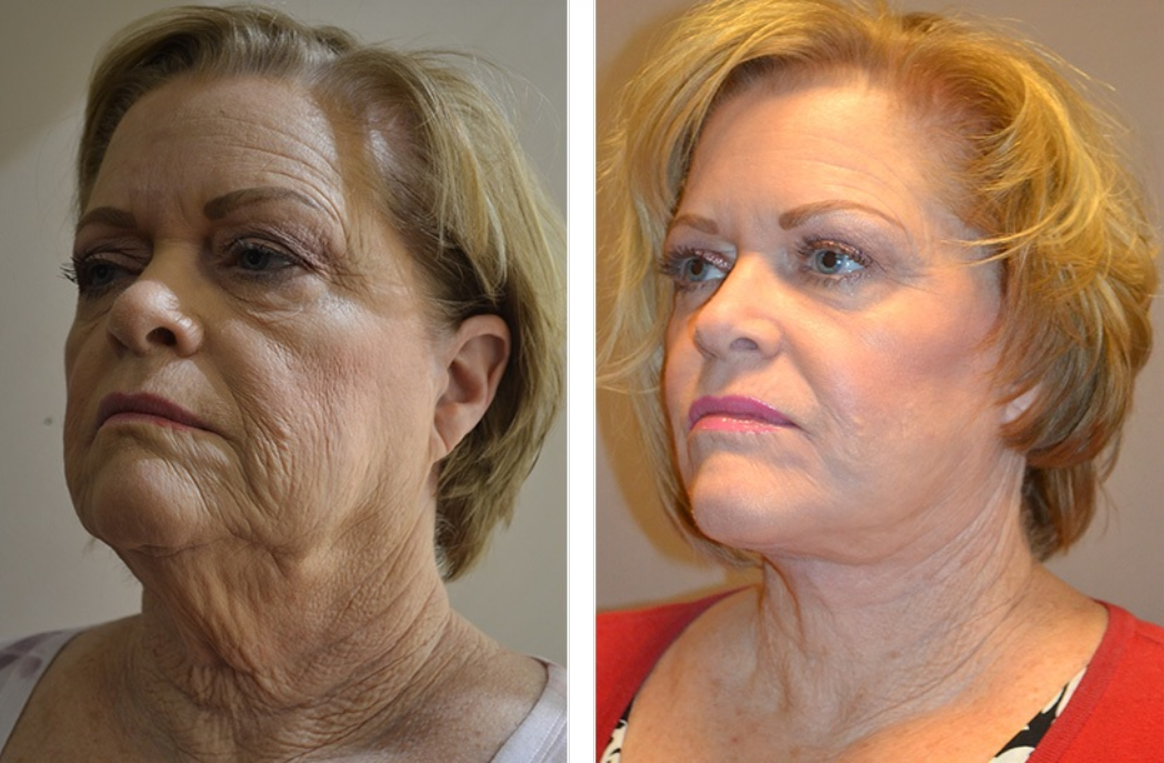 Before and after photos of a woman's face, showing tightened skin on the neck and cheeks.
