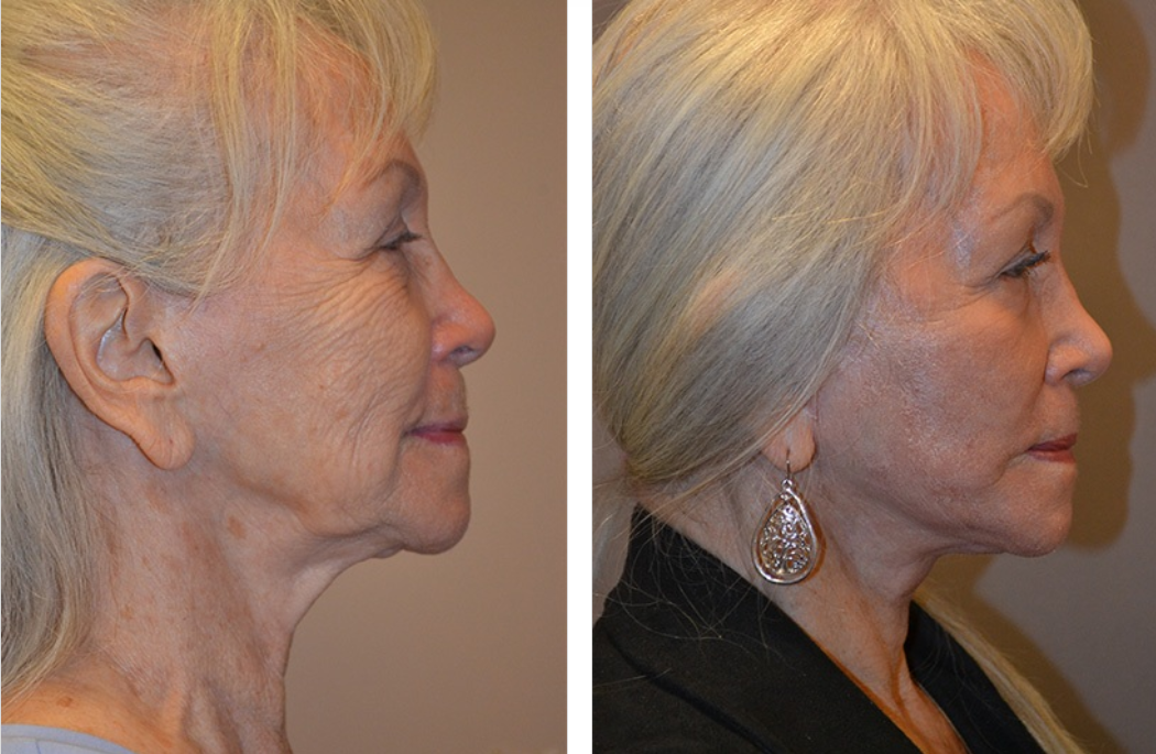 Before and after profile views of a woman's face, showing a visible reduction in wrinkles.
