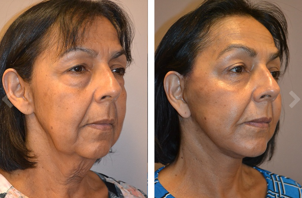 Before and after photos of a person's face; post-surgery, skin is tighter, less sag.