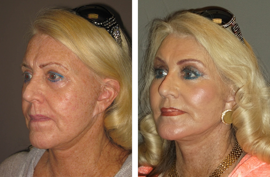 Before and after photos of a woman's face, showing smoothing of wrinkles and enhanced appearance.
