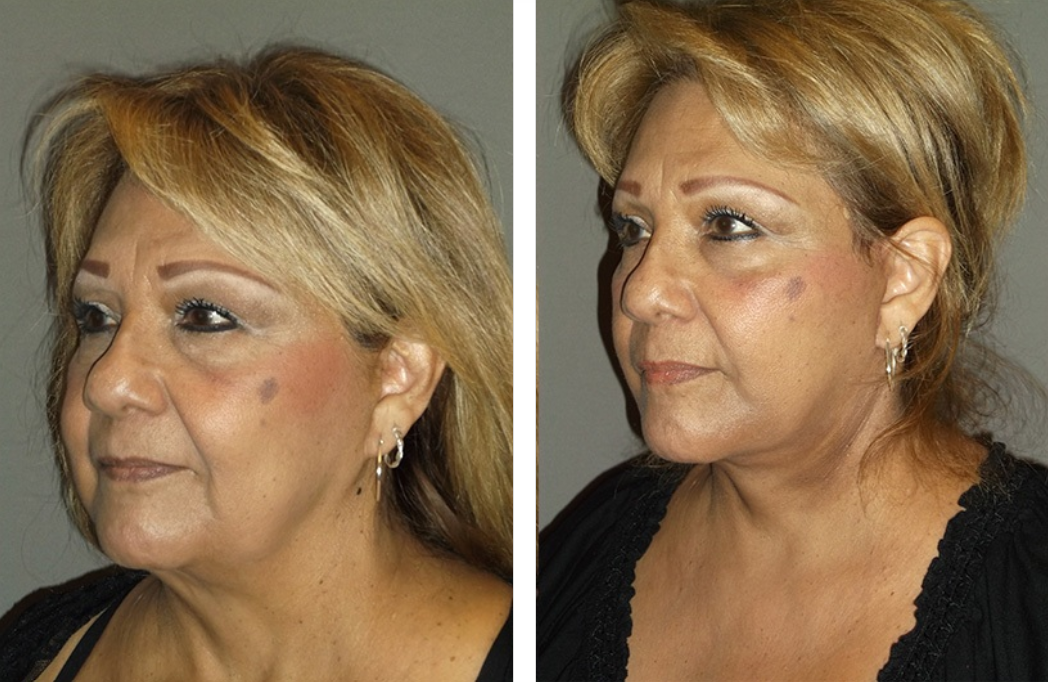 Two side-profile views of a person, before and after a cosmetic procedure, with a visible difference in neck and jawline.