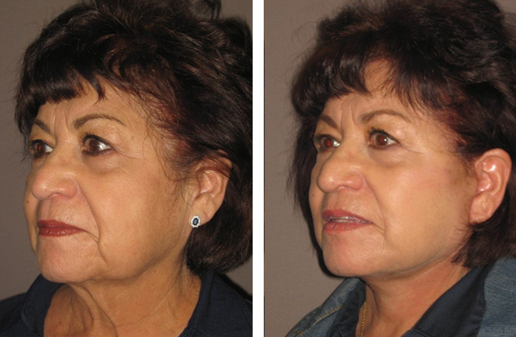 Two side-profile views of a woman's face, showing before and after facelift results.