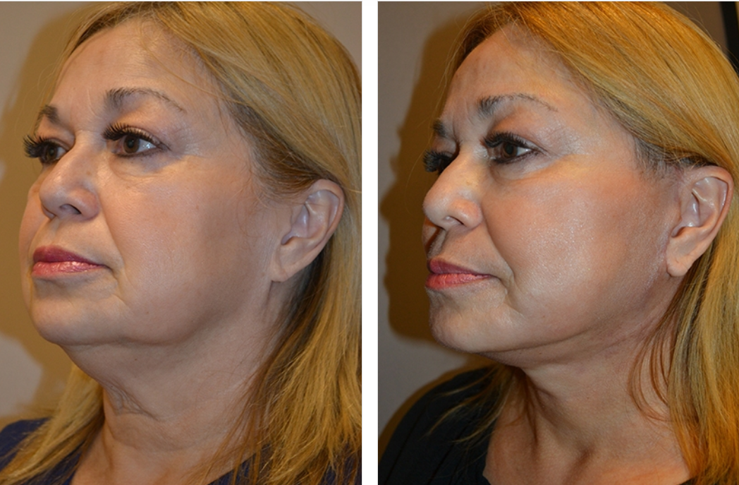 Before and after profile views of a person, showing a neck lift procedure.