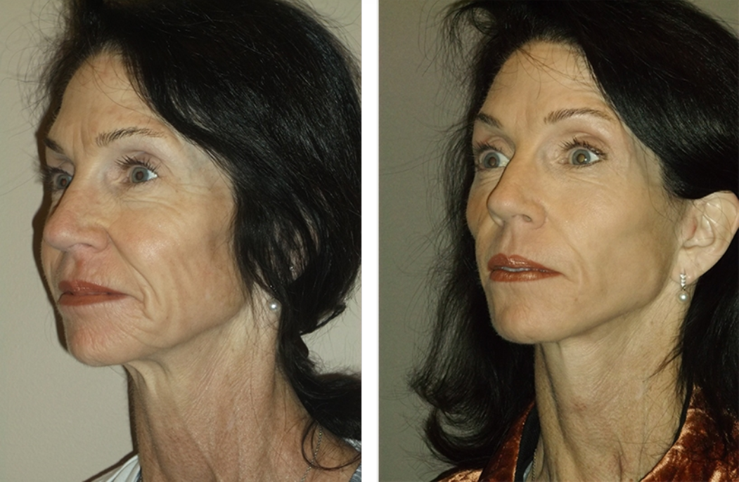 Before and after view of a woman's face, showing a decrease in wrinkles after a cosmetic procedure.