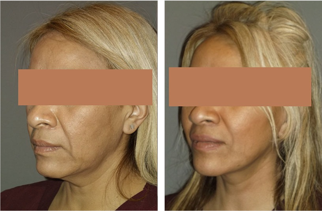 Before and after photos of a person's face, showing a reduction in wrinkles and sagging skin.