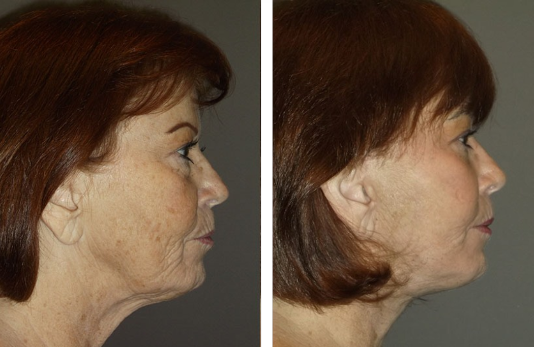 Side-by-side photos of a person. The left shows a wrinkled neck; the right has a smoother neck after cosmetic surgery.