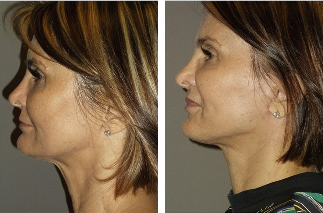 Before and after profiles of a woman's face, showing a cosmetic procedure.