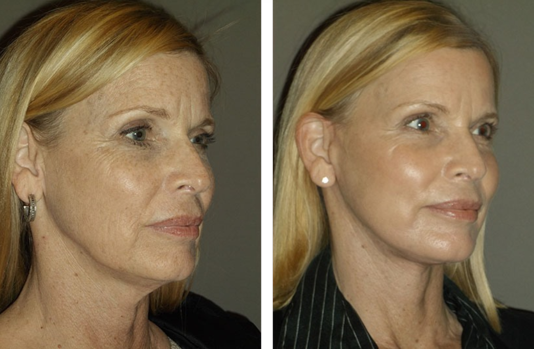 Before and after photos of a woman's face, showing a facelift's effect, including reduced wrinkles and tighter skin.