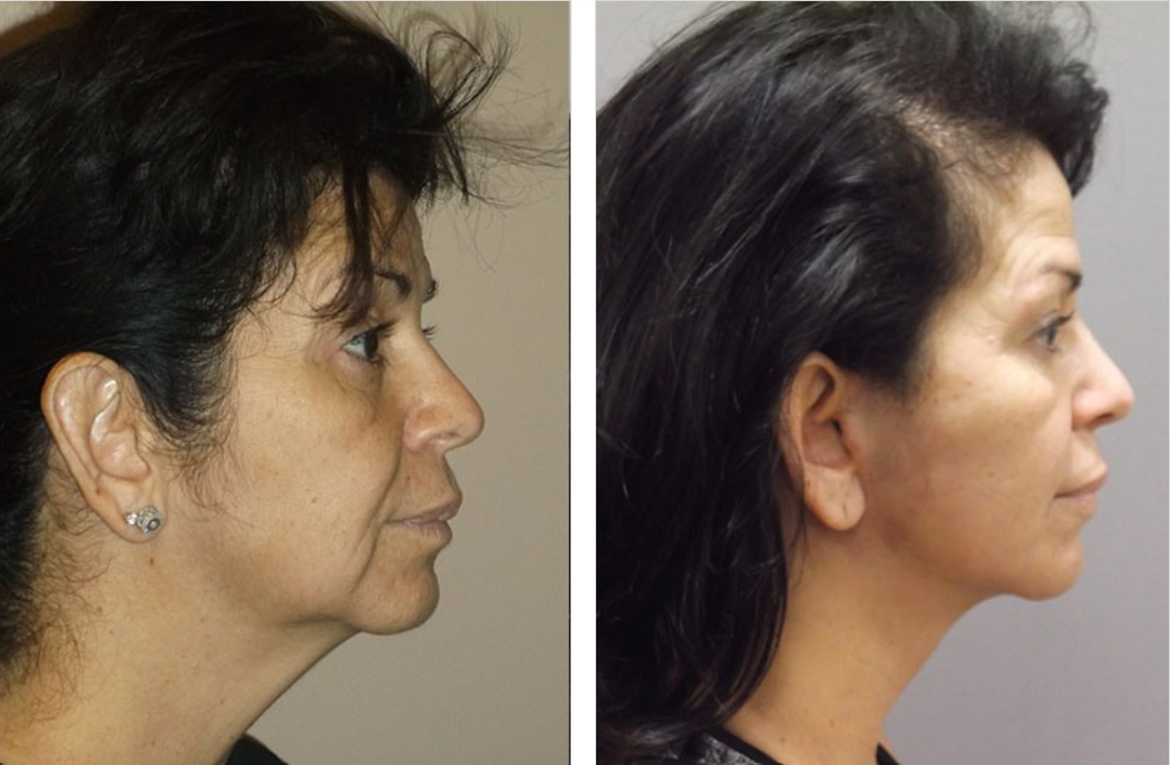 Side-by-side photos of a person. The left shows loose skin on the neck; the right shows a tighter neck.