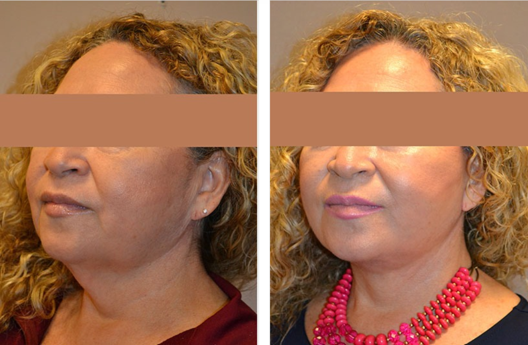 Before-and-after facial comparison. Woman's neck and jawline appear smoother after procedure.