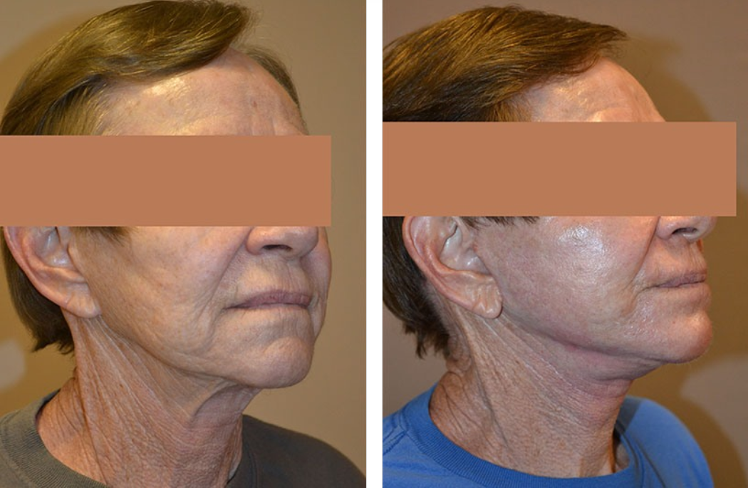 Side-by-side comparison of a person's face and neck before and after cosmetic surgery, showing a smoother appearance.