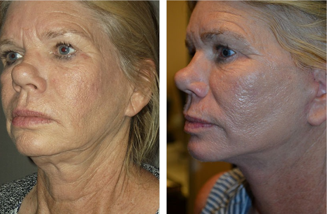 Before and after photos of a person's face; visible facial rejuvenation with less wrinkling and smoother skin.