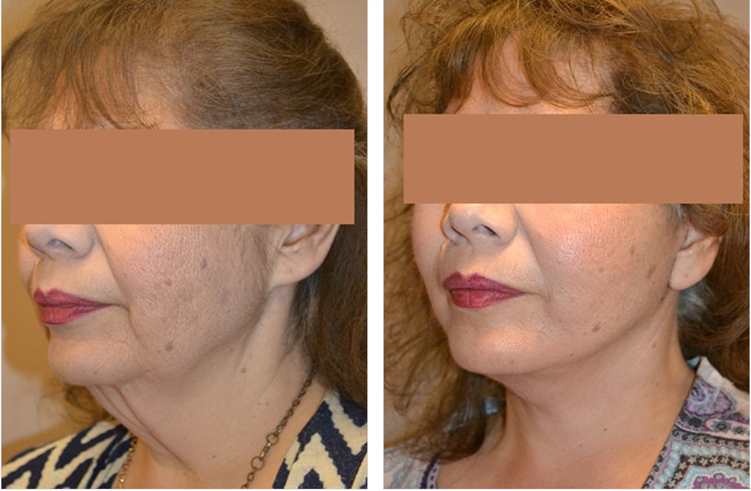 Side-by-side comparison of a person's face. Left side: before, showing wrinkles. Right side: after, showing smoother skin.