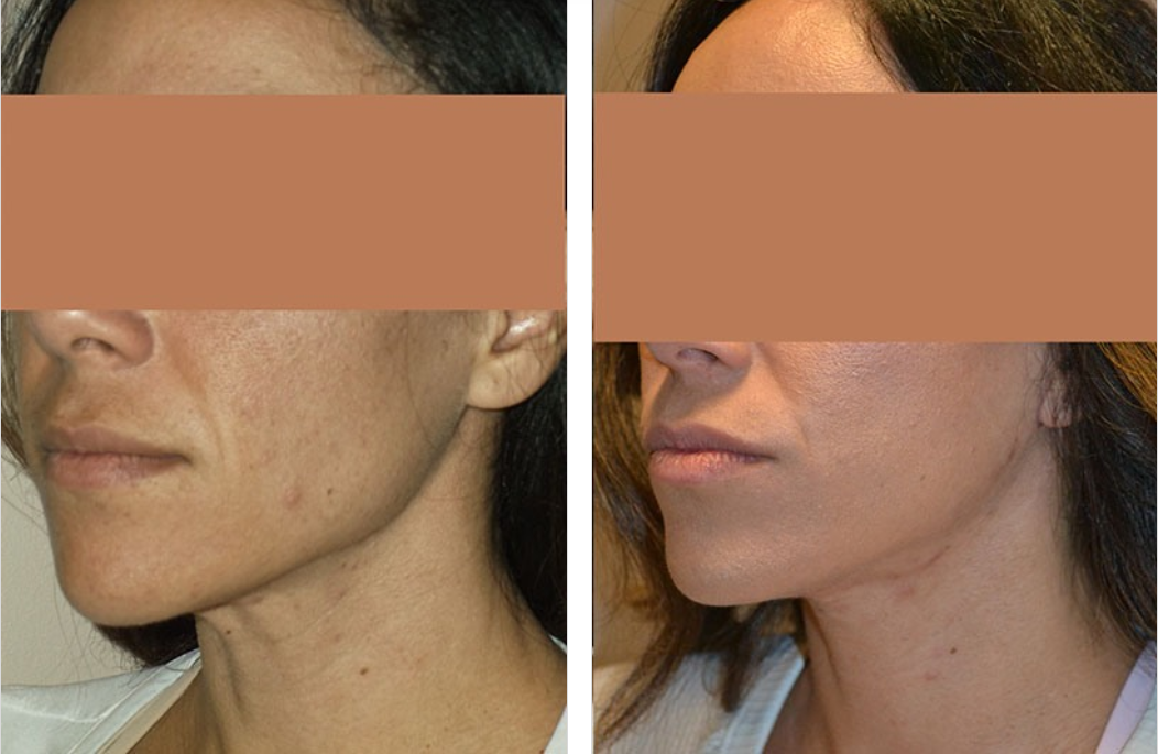 Comparison of a woman's face before and after a cosmetic procedure, showing a smoother jawline and neck.