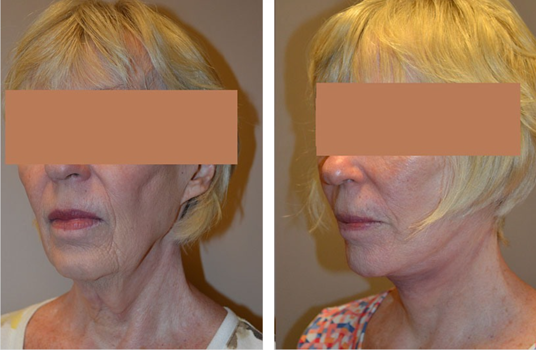 Before-and-after photos showing a woman's face and neck, with a visible reduction of wrinkles and sagging after a procedure.