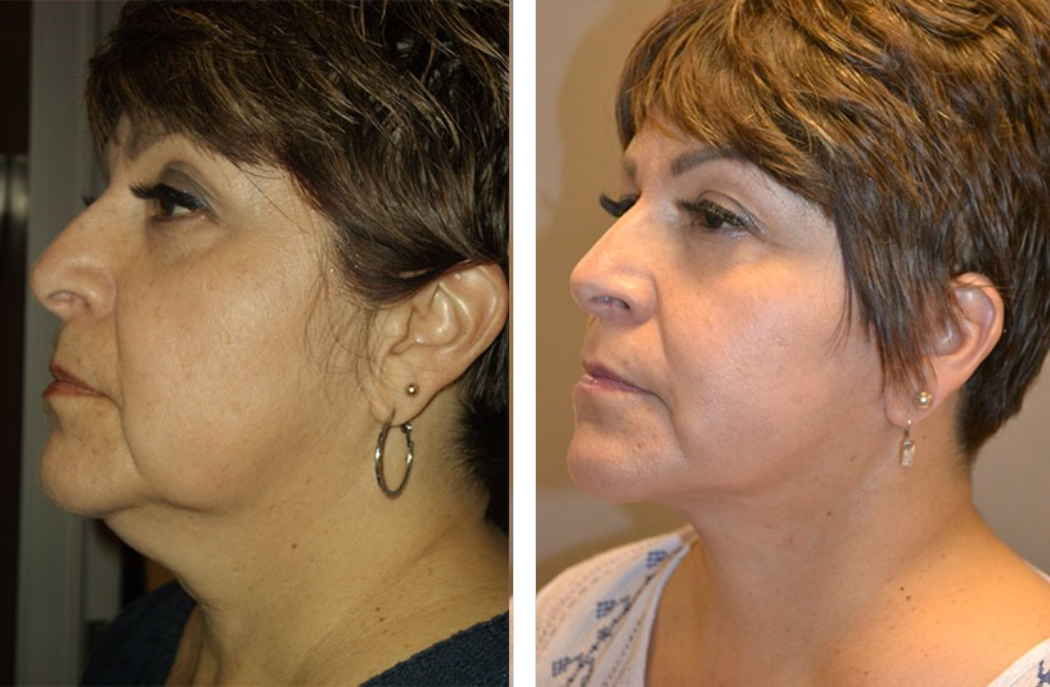 Before and after photos showing a woman's neck and jaw before and after cosmetic procedure.