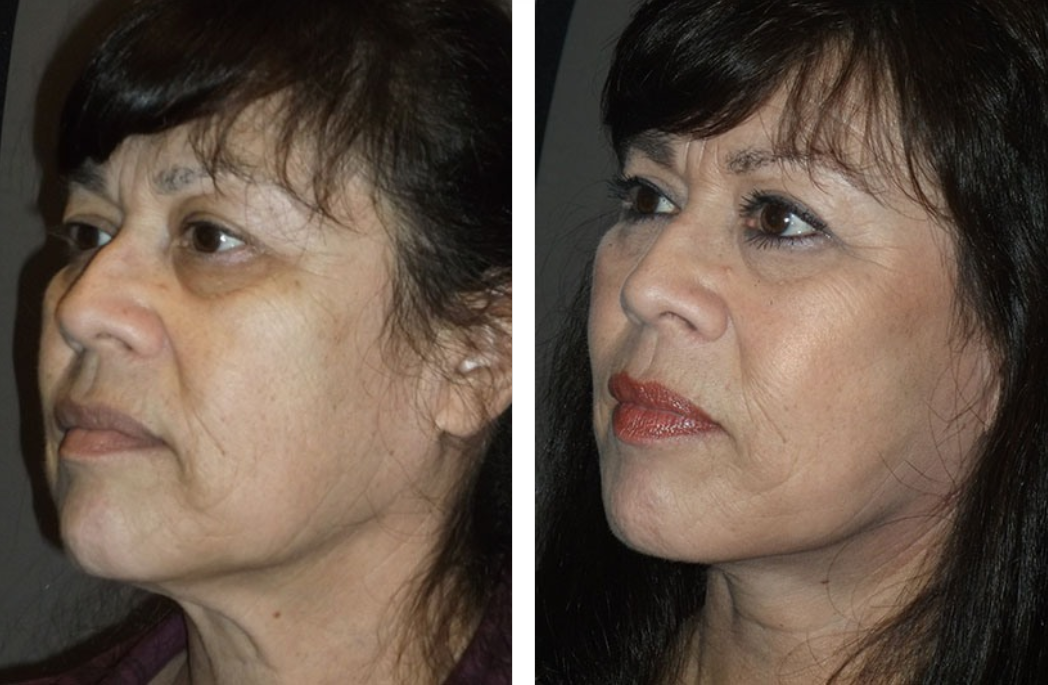 Before and after photos of a woman's face, showing a smoother, more lifted appearance after cosmetic surgery.