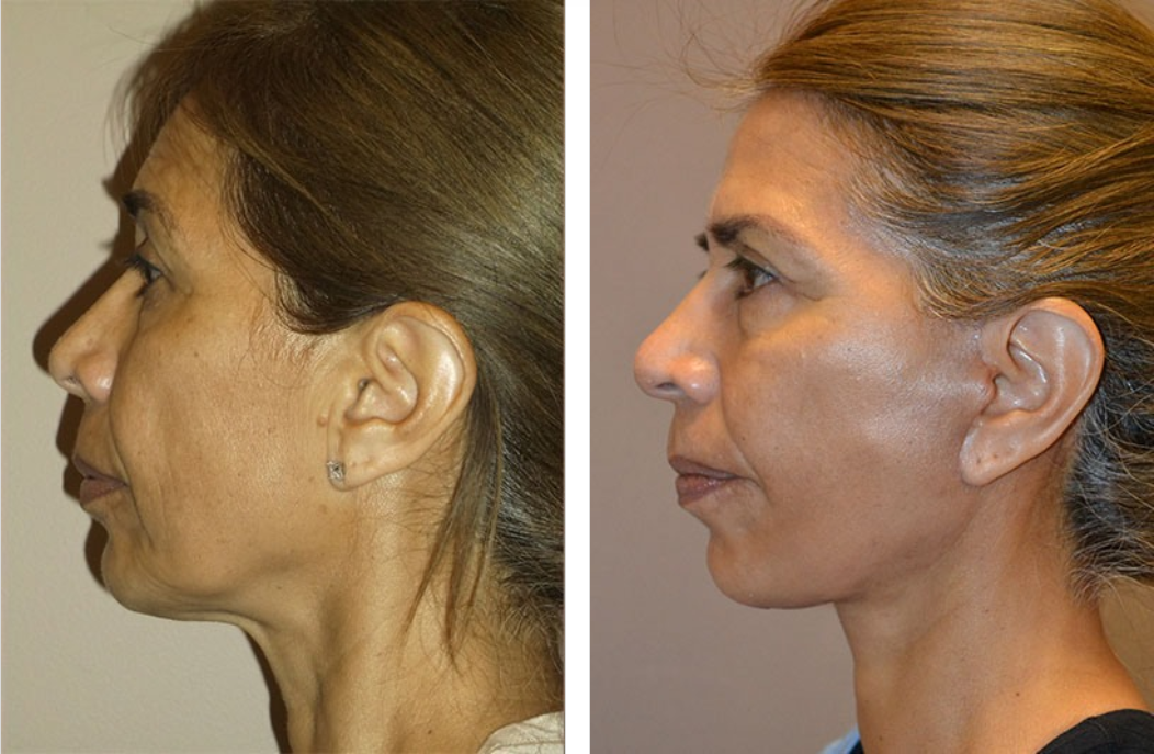 Profile view of a woman's face before and after cosmetic surgery. Skin appears smoother, jawline more defined.