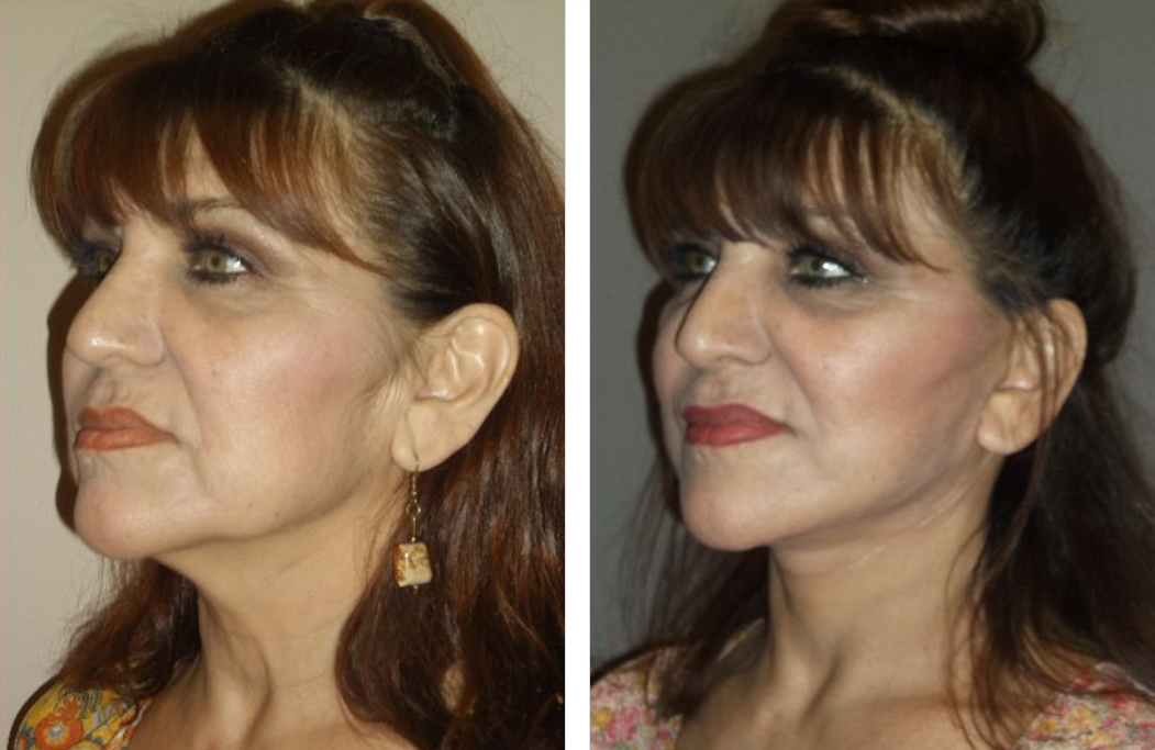 Before and after photos showing a woman with neck and facial rejuvenation.