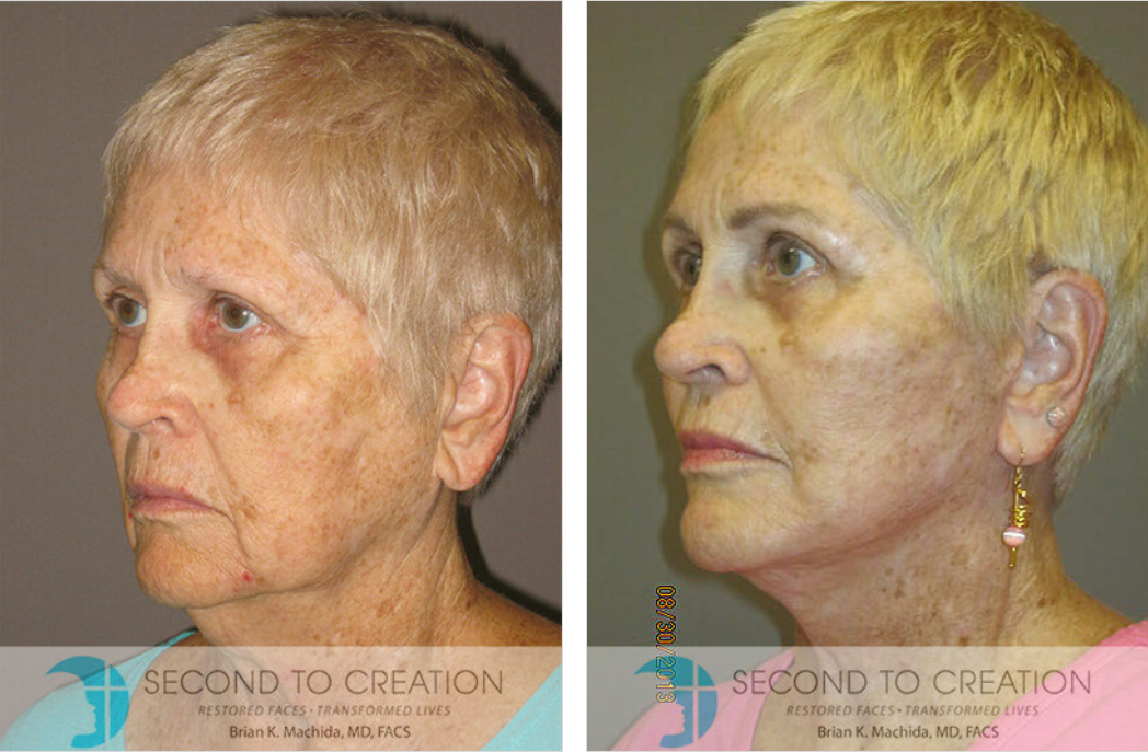 Side-by-side photos of a person's face. Left side shows wrinkles; right side shows smoother skin after a procedure.