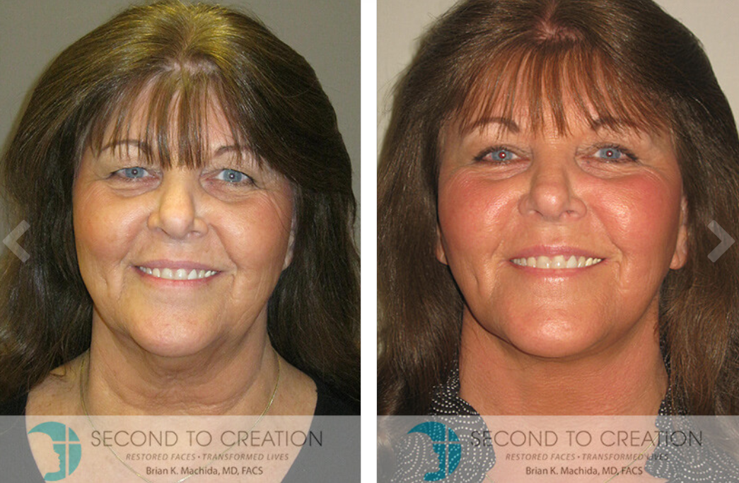 Side-by-side photos of a woman before and after a cosmetic procedure, showing a smoother neck and face.