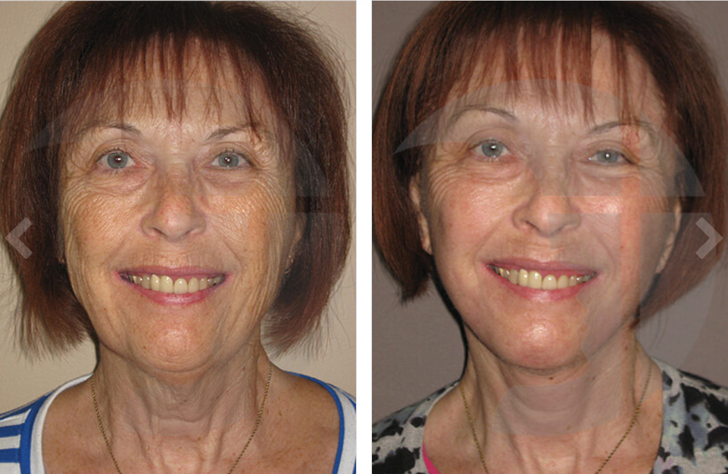 Before and after photos showing an older woman’s face, with reduced wrinkles and smoother skin after a procedure.
