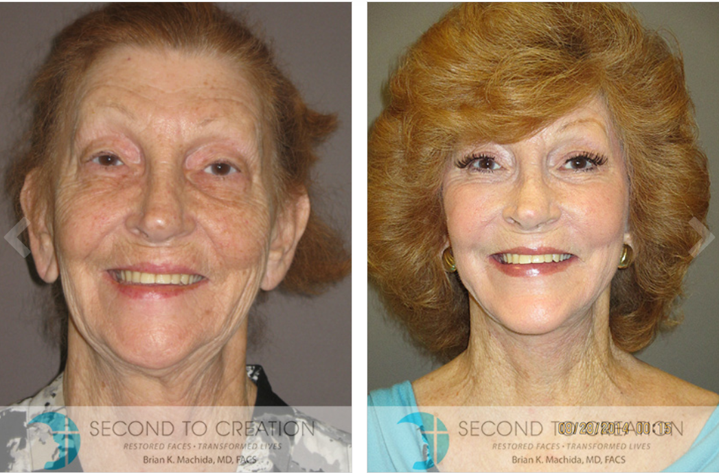 Before and after photos of a woman's face. After shows smoother skin, and a brighter smile.