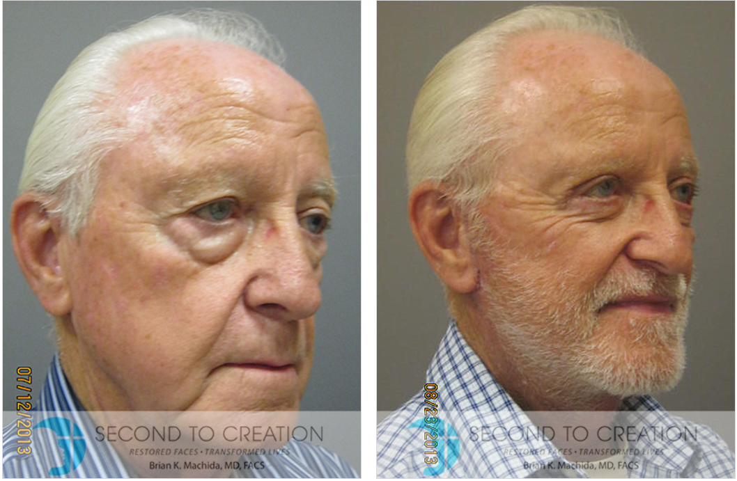 Before and after photos showing an older man's face, with a reduction in wrinkles and eye bags.