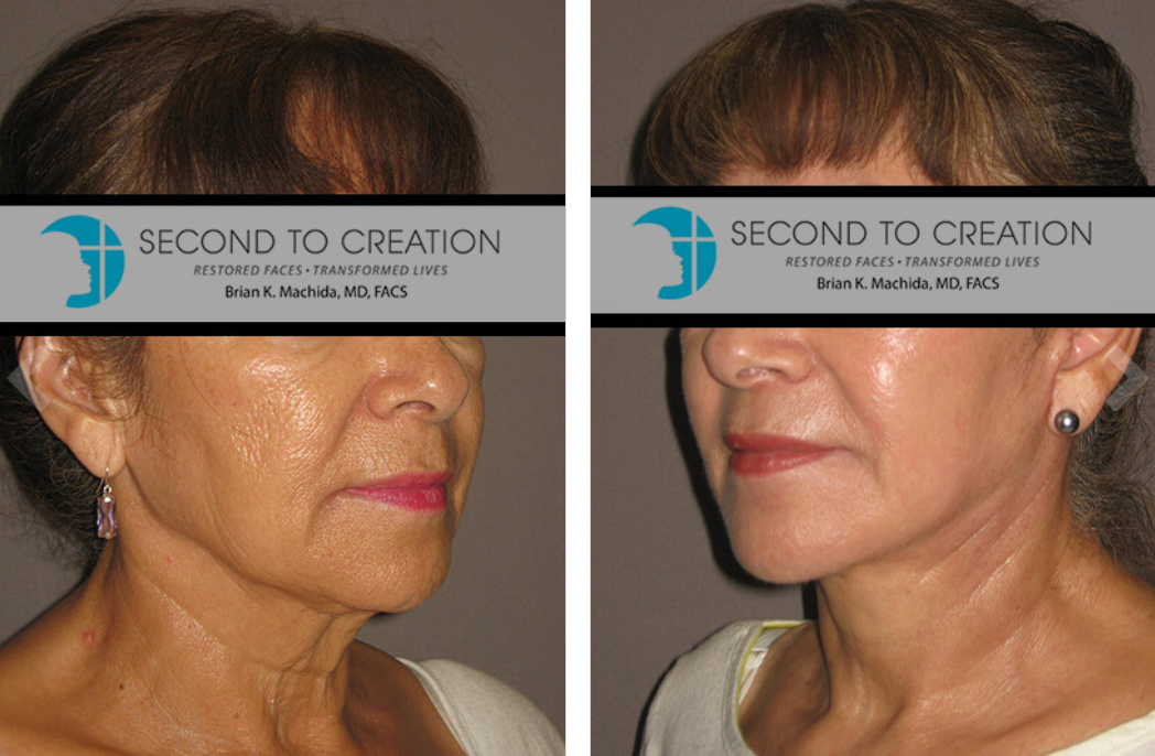 Before and after facial rejuvenation photos. Wrinkles and sagging skin reduced.