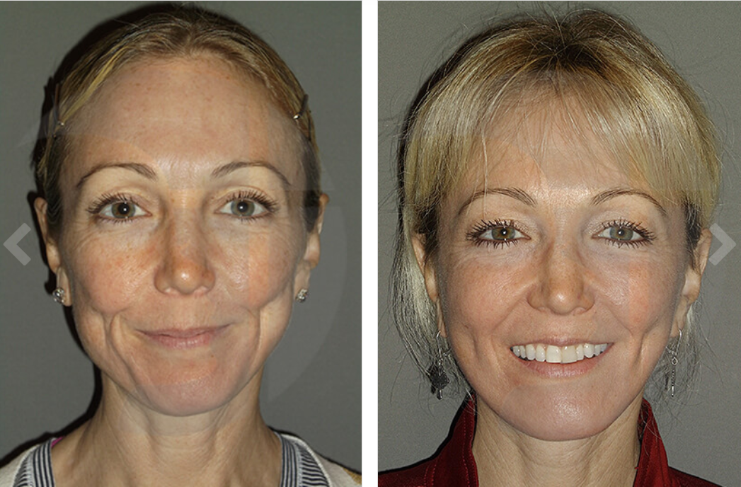 Before-and-after facial comparison: left, woman with neutral expression; right, smiling woman with fuller features.