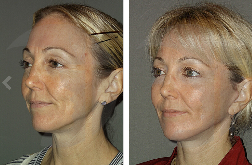 Before and after photos showing facial skin rejuvenation, reducing wrinkles, and improving complexion.