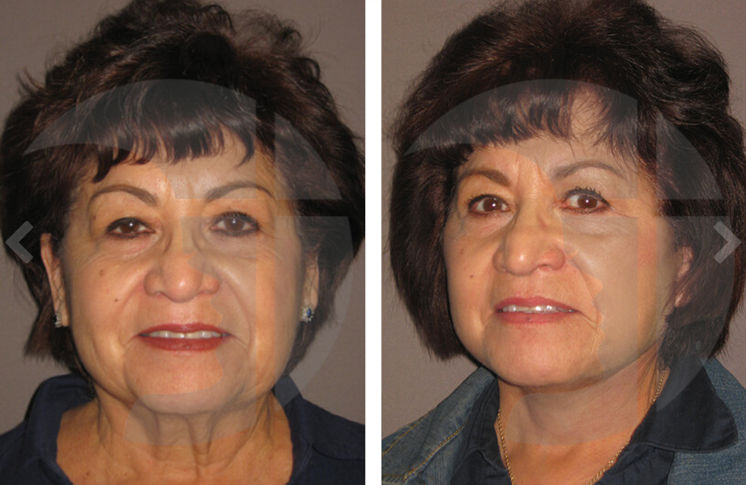 Side-by-side comparison of a person's face. Left shows more wrinkles, right shows smoother skin.