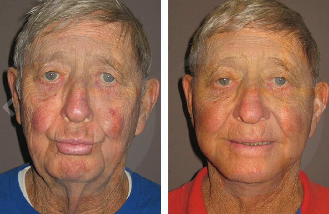 Before and after facial surgery, man with skin redness and a new smile.