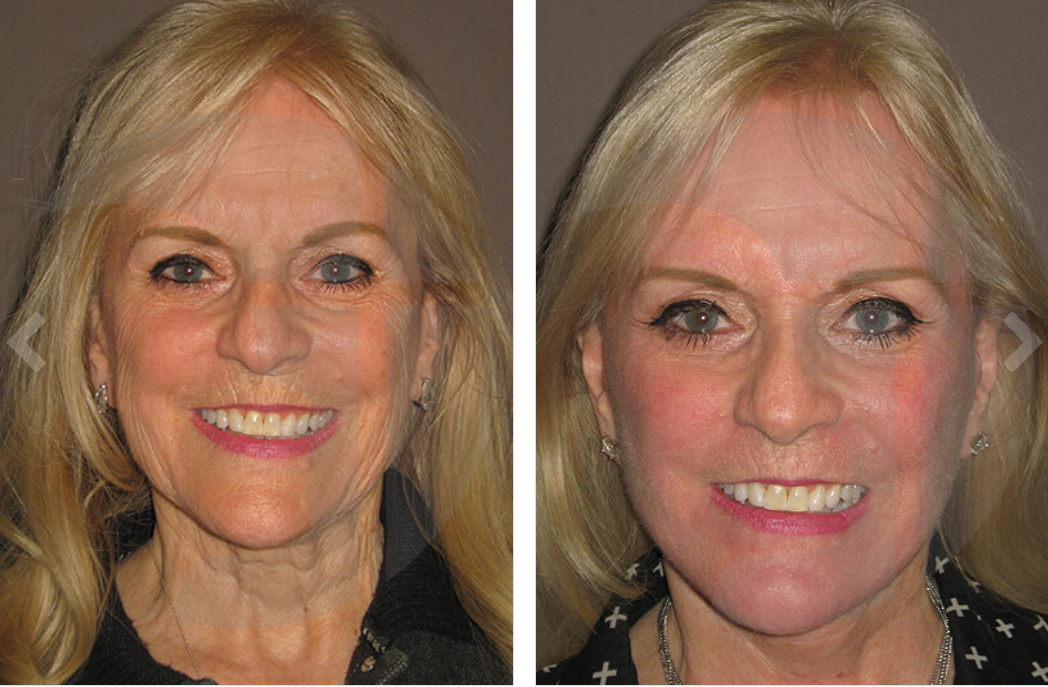 Before and after close-up photos of a person's face. Shows smoother skin, and reduced wrinkles after cosmetic procedure.