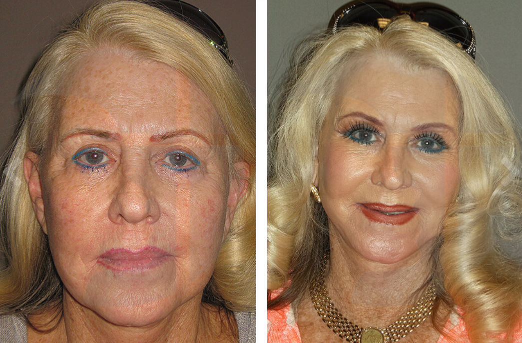 Before-and-after facial comparison of a woman with wrinkled skin and a more youthful appearance.