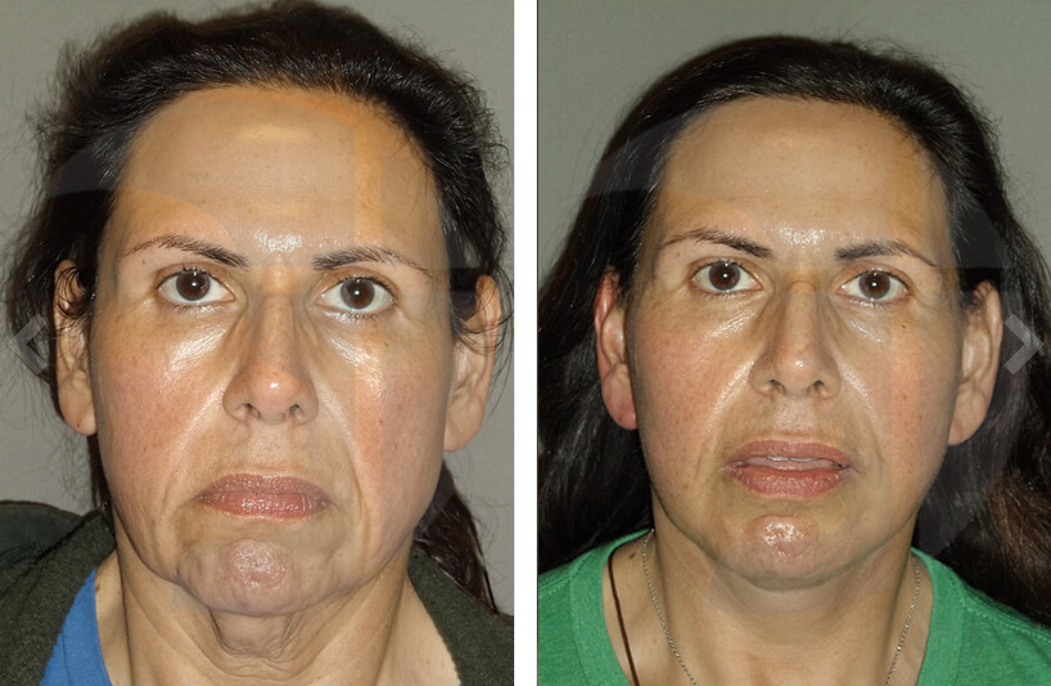 Before-and-after facial comparison. Woman's face shows reduced wrinkles and tightened skin after a procedure.