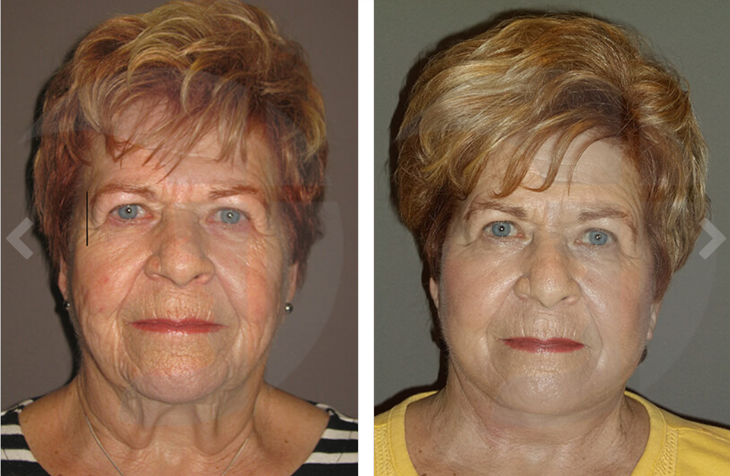 Side-by-side photos of a woman's face before and after a cosmetic procedure. The after photo shows a smoother appearance.