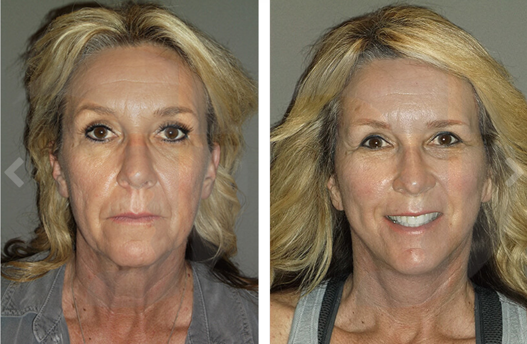 Before and after photos of a woman's face, showing a decrease in wrinkles and an enhanced smile.