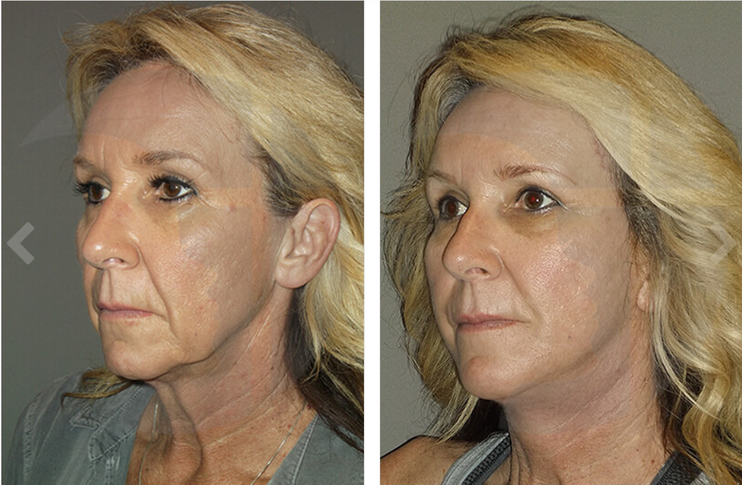 Before and after facial rejuvenation photos: woman with improved skin and reduced wrinkles.