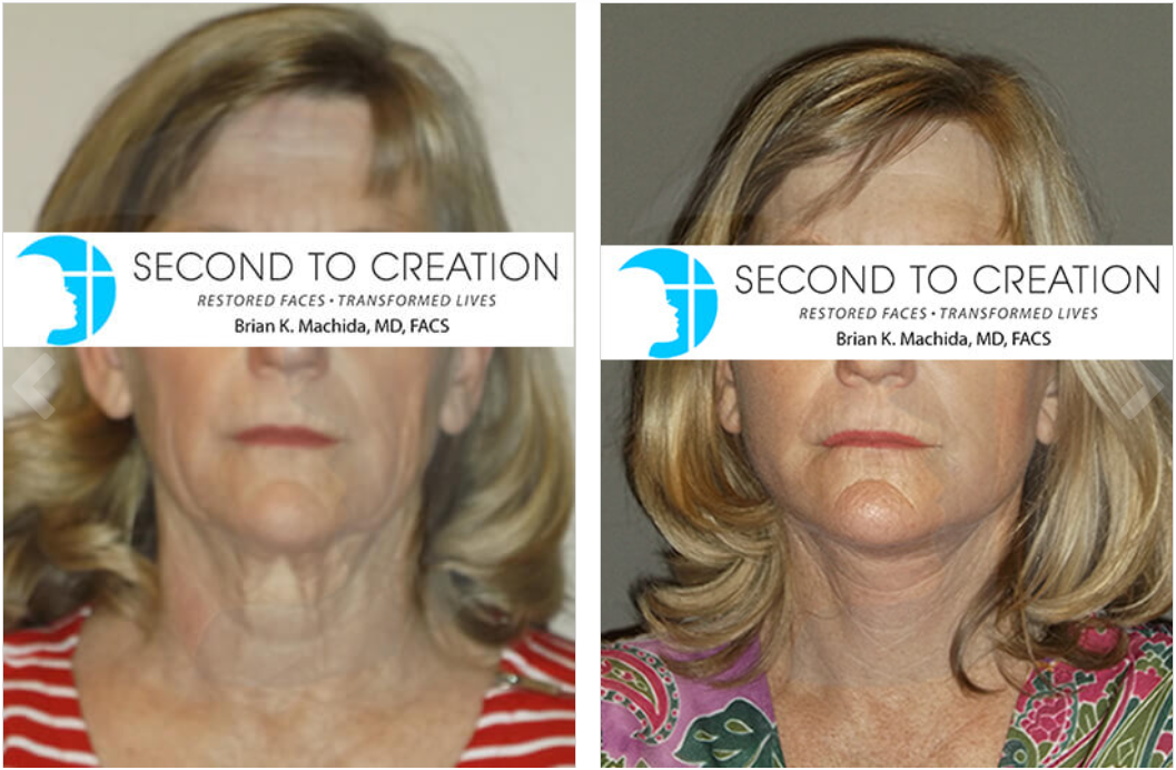 Before and after comparison of a woman's face and neck, showcasing cosmetic surgery results.