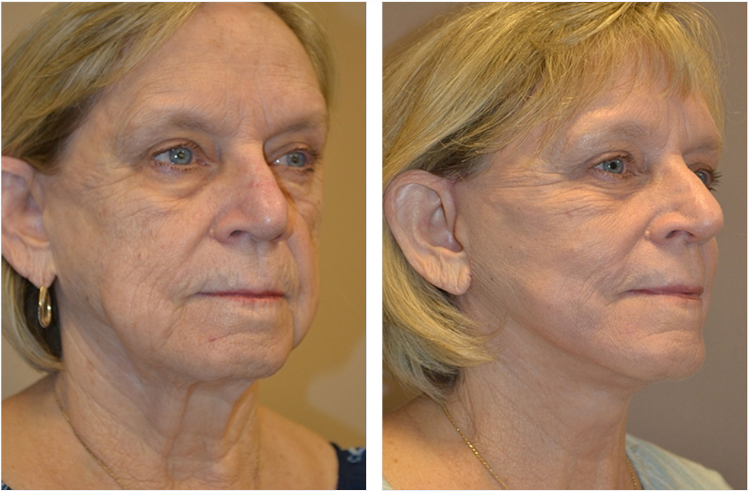 Before and after photos of a woman's face, showing a smoother appearance after a procedure.