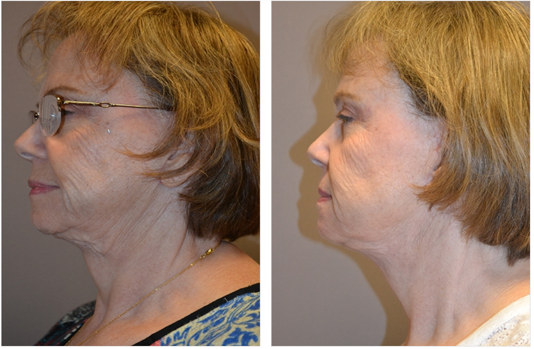Before and after profile views of a woman's face and neck, showing reduced wrinkles and tighter skin.