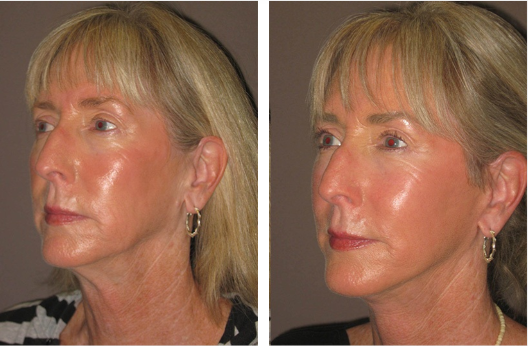 Before-and-after facial surgery comparison of a woman. The after photo shows a tighter jawline, less wrinkles.