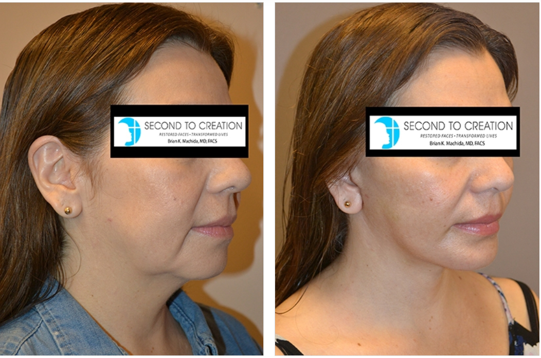 Side-by-side comparison shows a woman's face before and after a cosmetic procedure, with reduced sagging.
