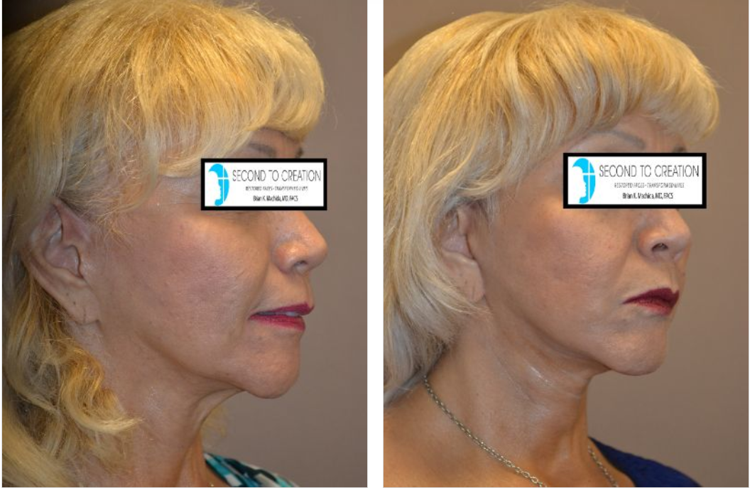 Before and after facelift photo. Woman with improved jawline, neck, and reduced wrinkles.