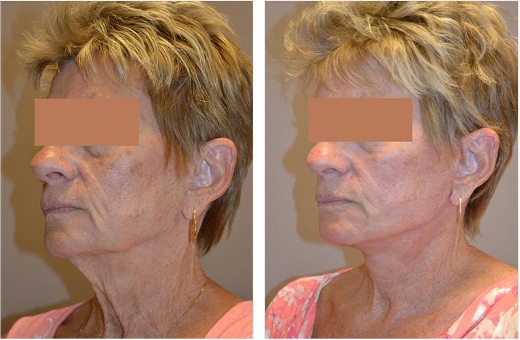 Before-and-after of a neck lift; a woman's neck shows visible skin tightening from wrinkles.