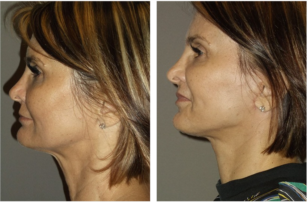Side-by-side comparison: woman's profile before and after cosmetic surgery, showing neck and jawline improvements.