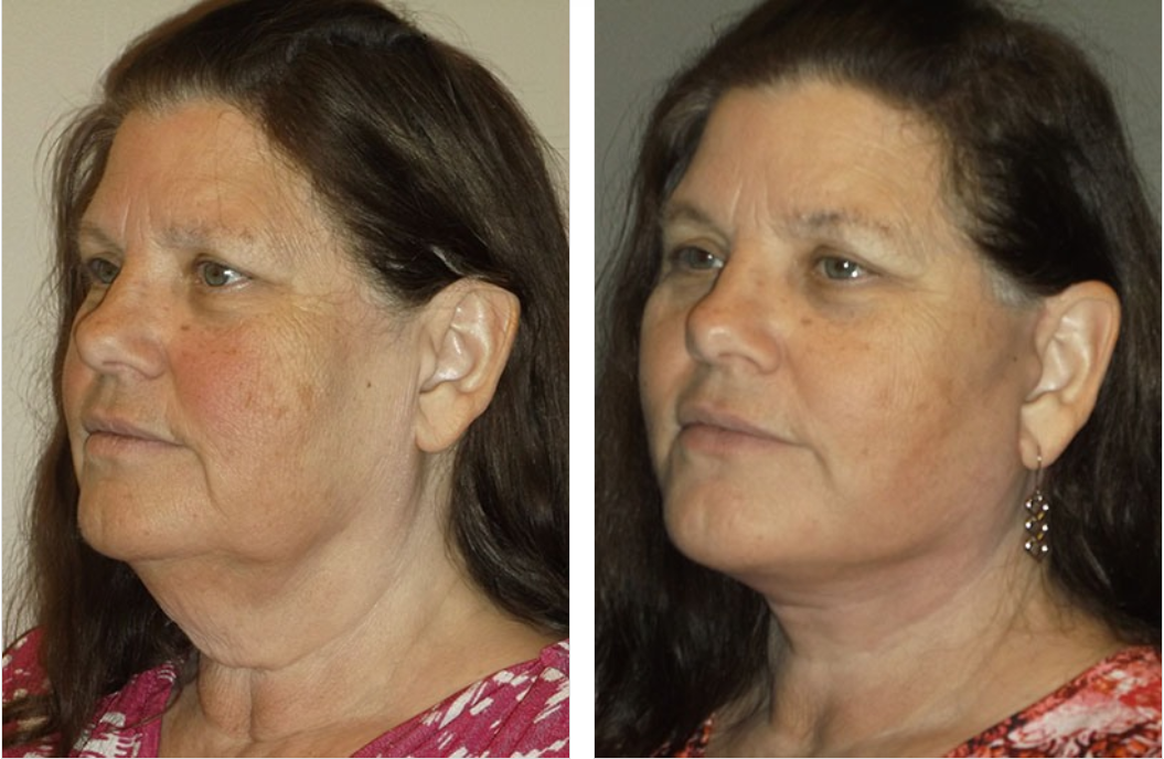 Woman's face: before and after. Left: sagging neck. Right: smoother, tighter appearance after a procedure.