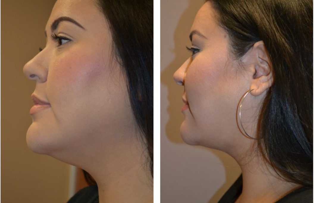 Before-and-after of a person's profile. Left shows full face, right shows a more defined jawline.