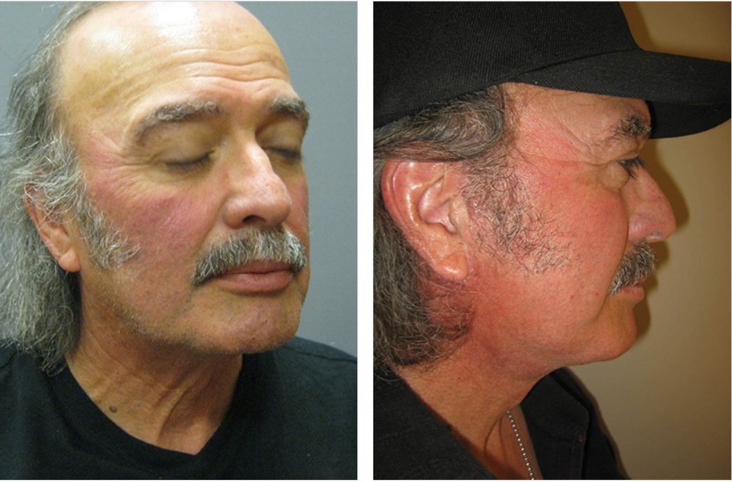 Man with visible redness on face in two views: front and profile.